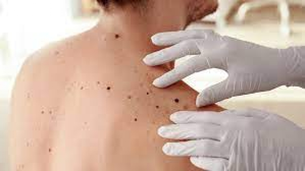 Cáncer de piel: advierten que lesiones inofensivas o lunares podrían ser &quot;signo de alarma&quot;
