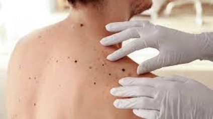 Cáncer de piel: advierten que lesiones inofensivas o lunares podrían ser "signo de alarma"