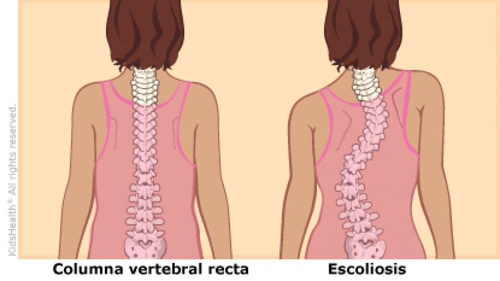 ¿Qué es la Escoliosis? causas, síntomas y tratamientos para esta curvatura anormal de la columna